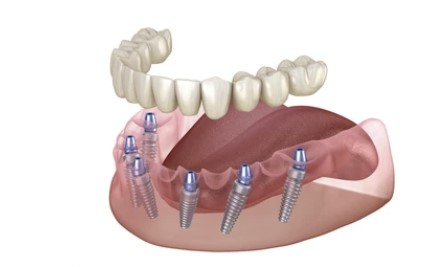 all on 6 implant treatment turkey