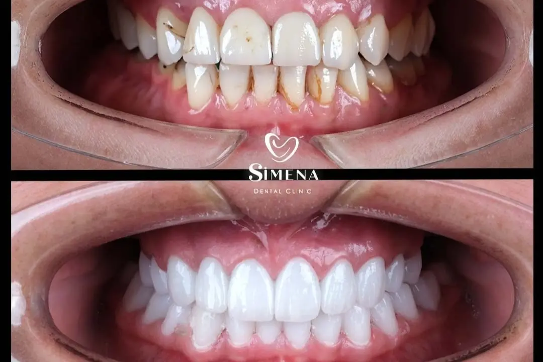 Black stripes on teeth before after Black stripes on teeth before after