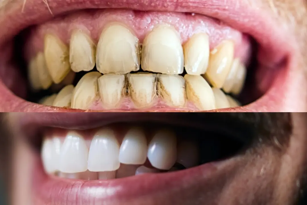 How to remove black stripes on dental crowns? How to remove black stripes on dental crowns?