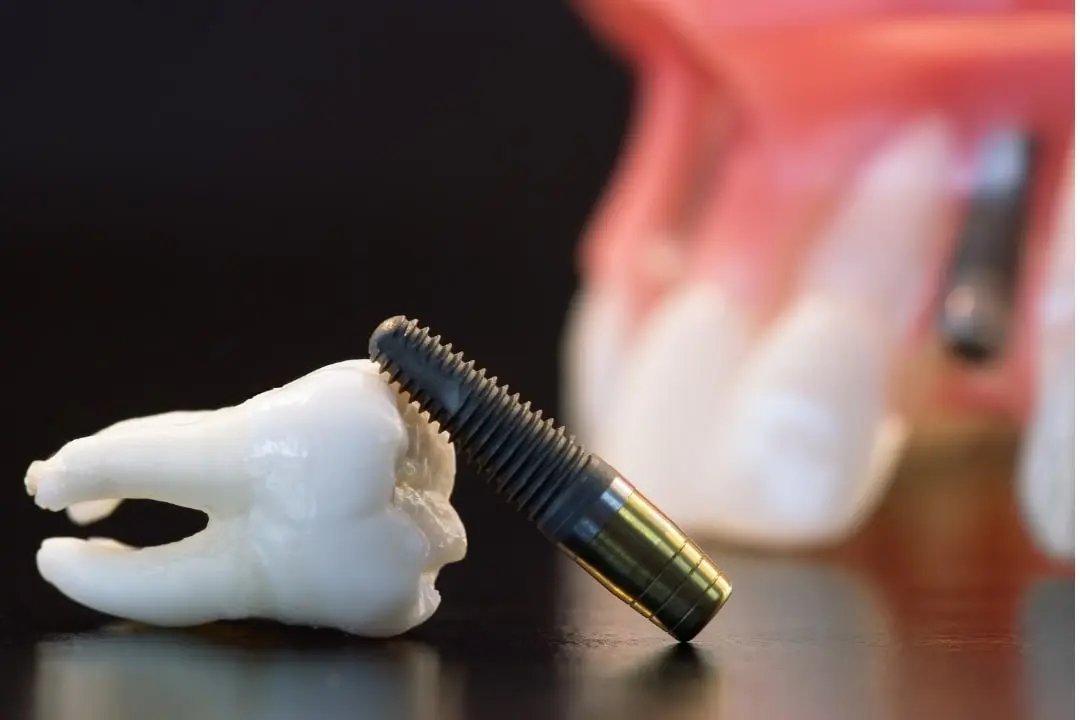 Can anyone get dental implants?