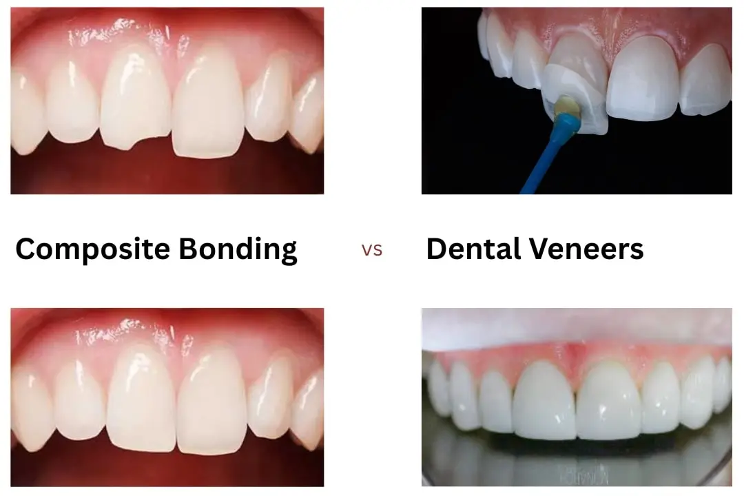 Composite Bonding vs Veneers: Which is right for me?