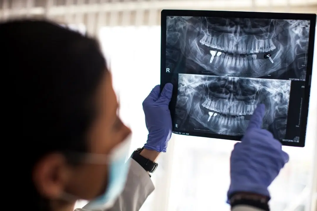 About dental implant aftercare