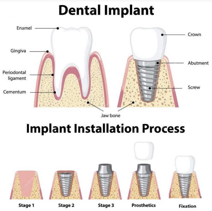 dental implants procedure