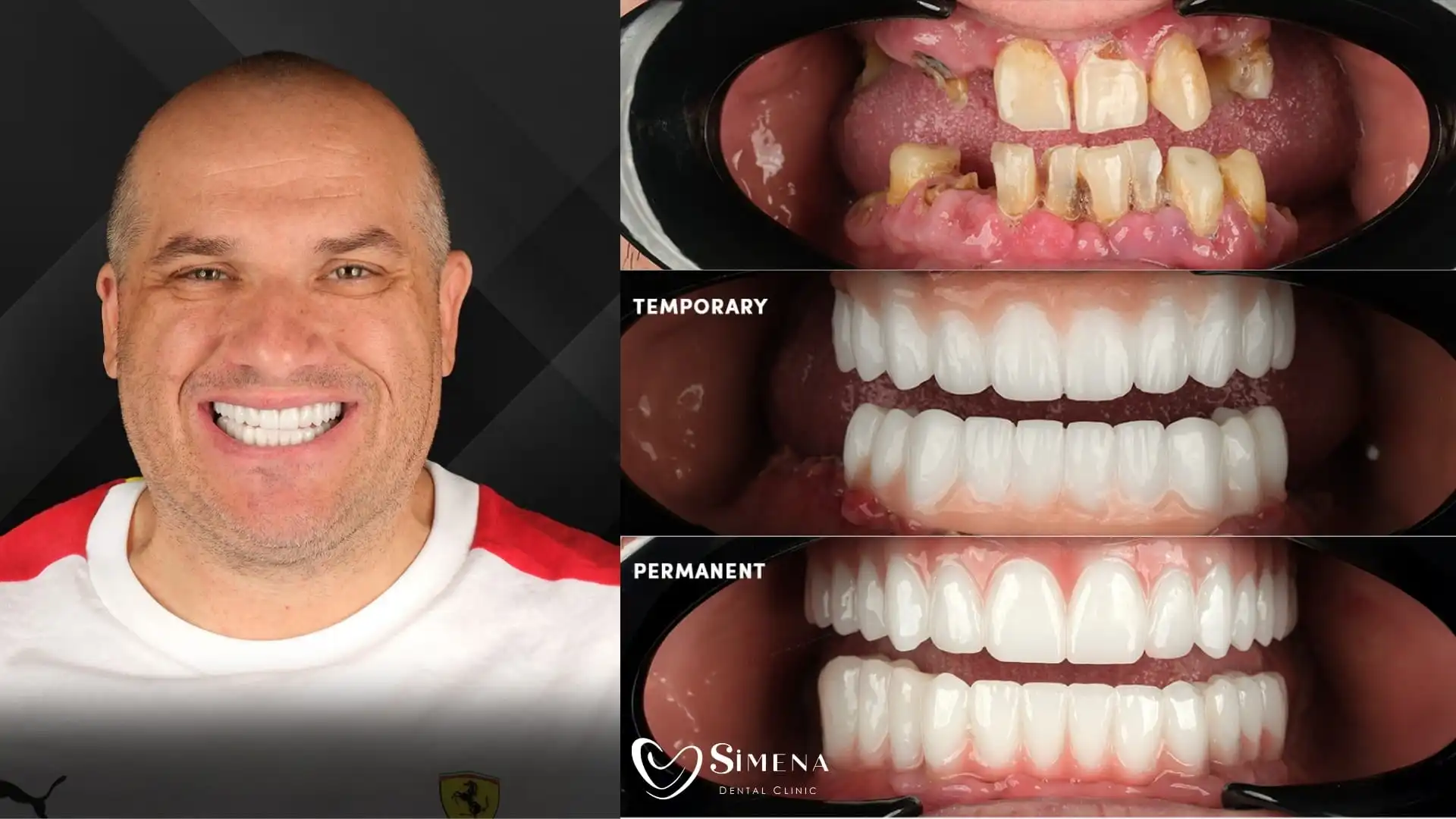 Get dental implants in Antalya at Simena Dental Clinic