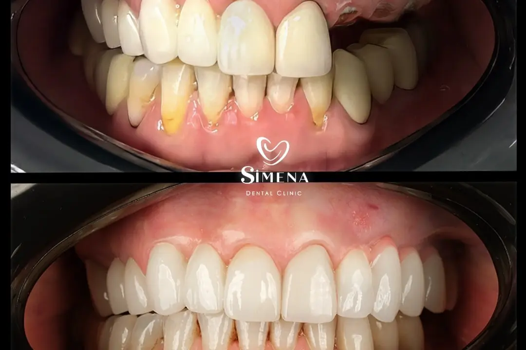 Dental implant treatment Turkey dental implants turkey