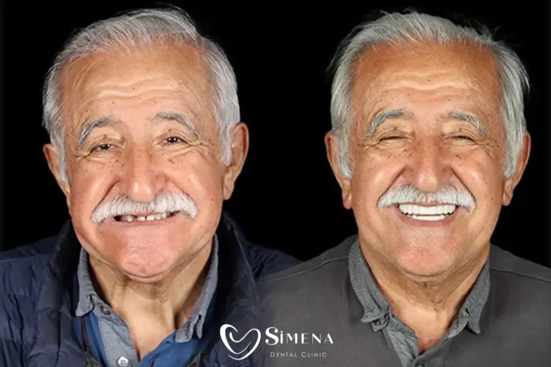 Dental Implants Turkey Before After Dental Implants Turkey Before After