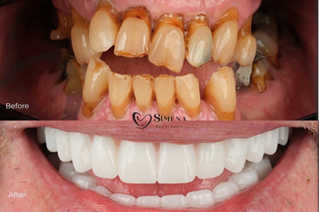 How long can you keep your teeth with periodontal disease? How long can you keep your teeth with periodontal disease?