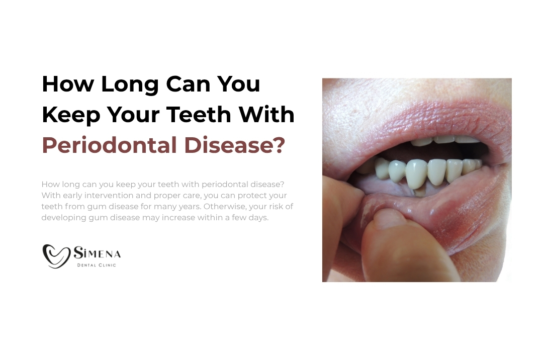 How long can you keep your teeth with periodontal disease? How long can you keep your teeth with periodontal disease?