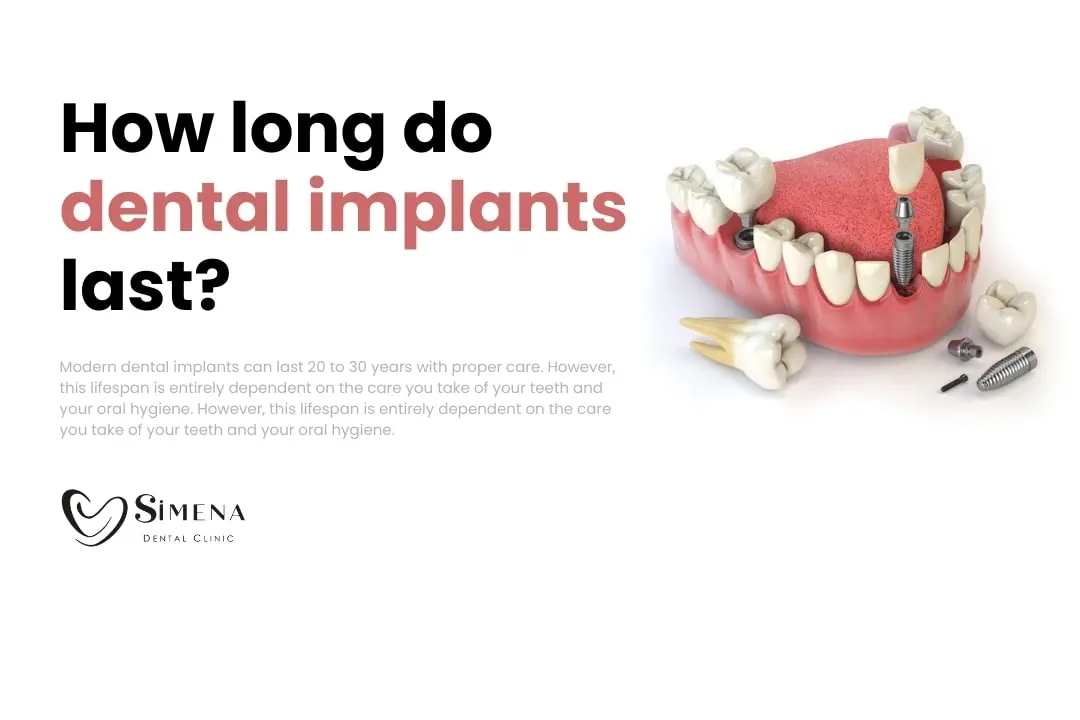 How long do dental implants last? How long do dental implants last?