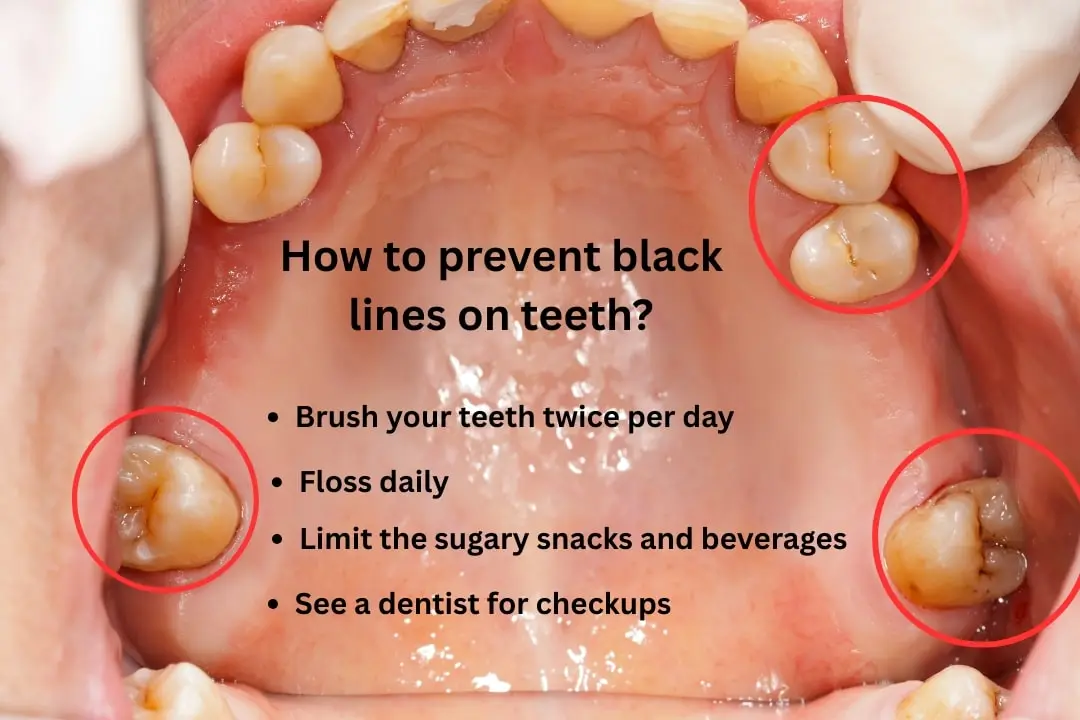 How to prevent black lines on teeth? How to prevent black lines on teeth?