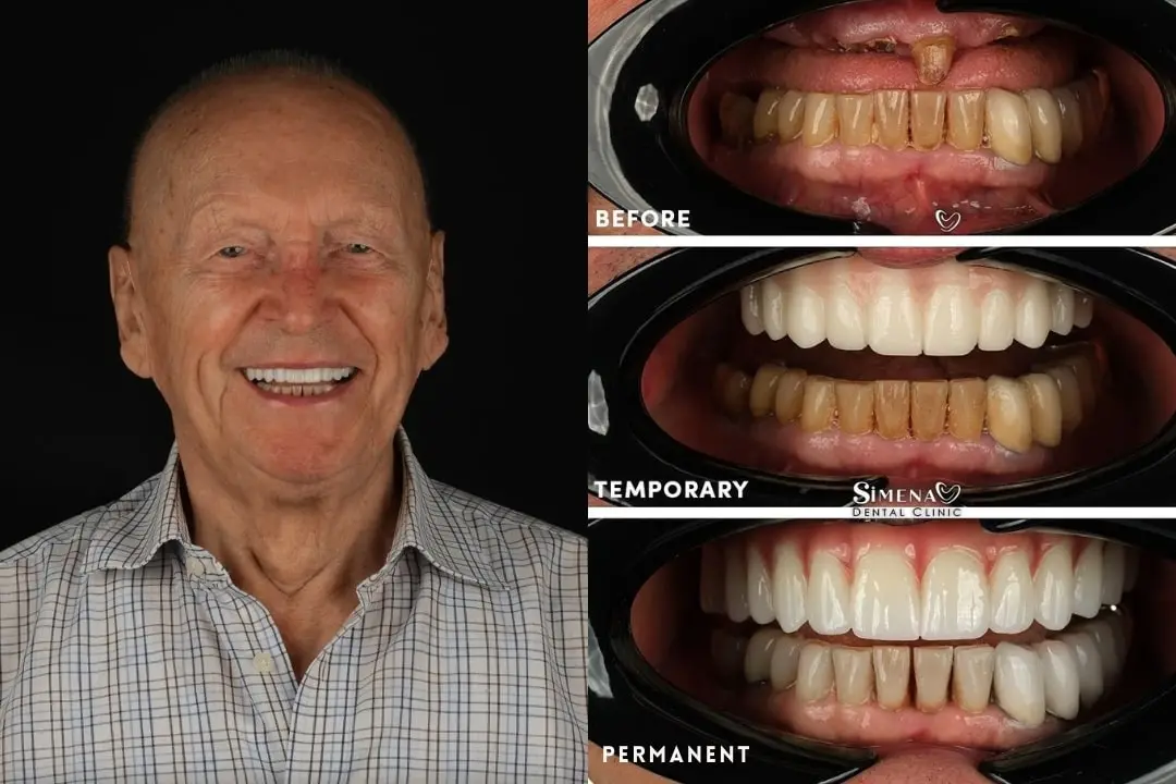 Is it safe to have dental implants in Turkey?