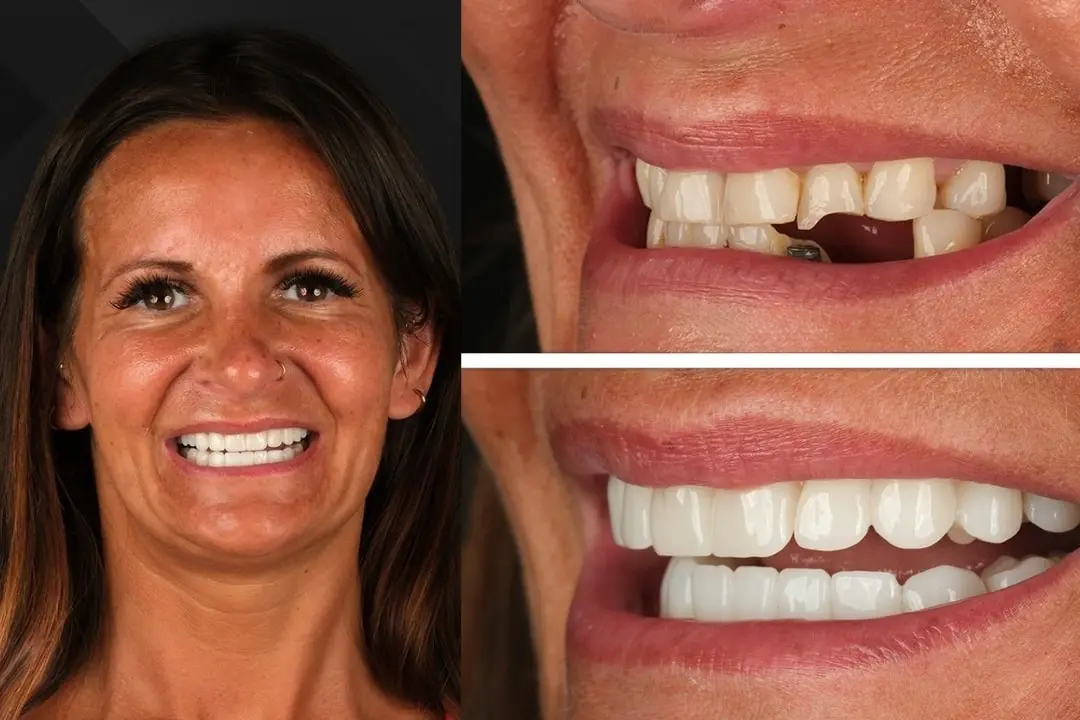 Is it safe to have dental implants in Turkey?