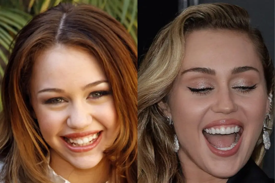 Miley Cyrus Teeth Before and After