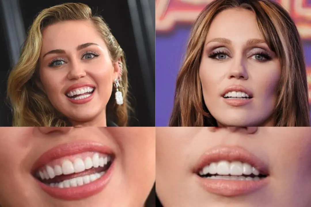 Miley Cyrus teeth veneers Miley Cyrus teeth veneers