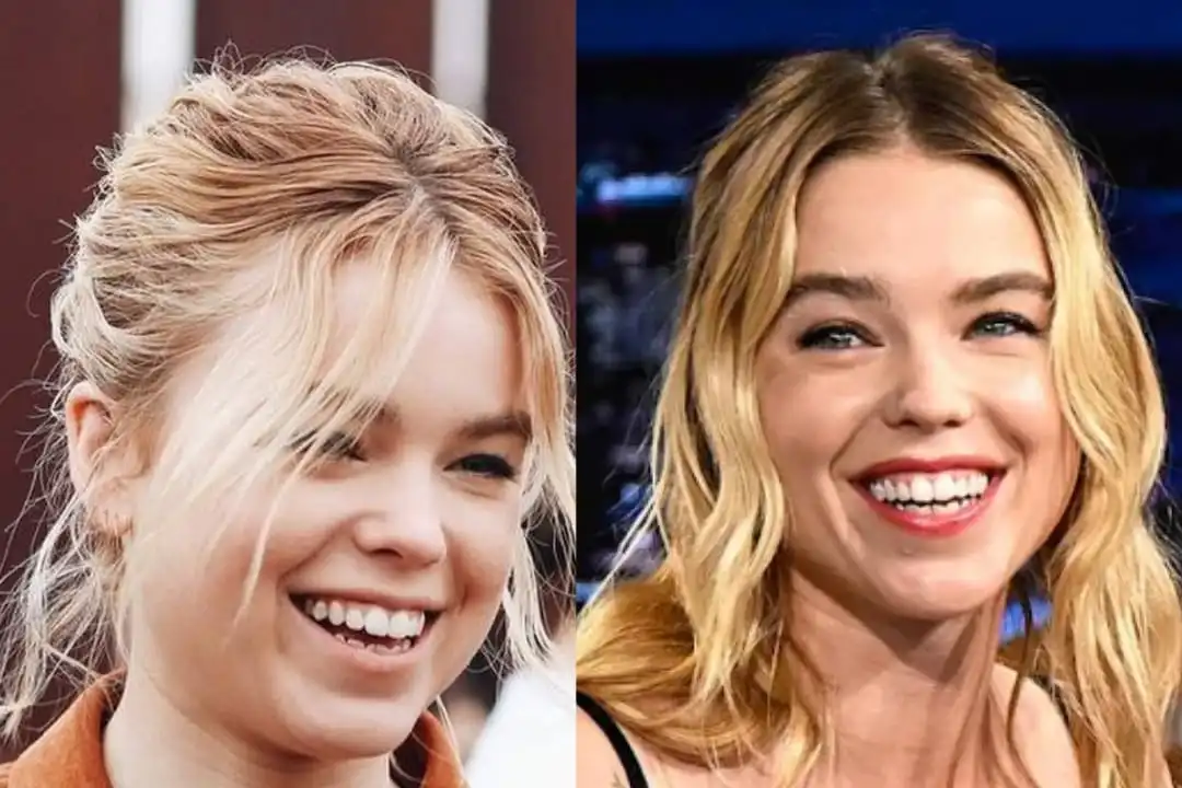 Milly Alcock's teeth before and after