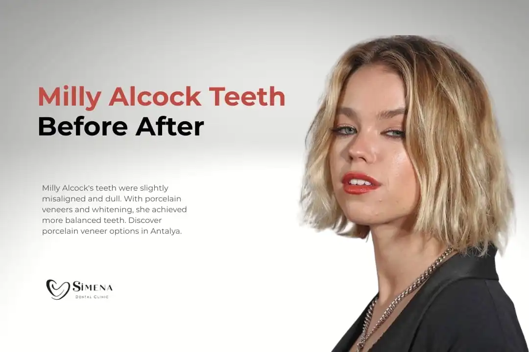 Milly Alcock Teeth Before After