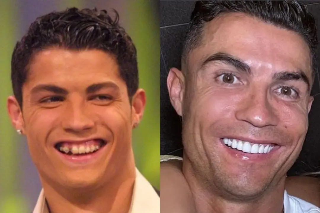 Cristiano Ronaldo teeth implant Cristiano Ronaldo teeth implant
