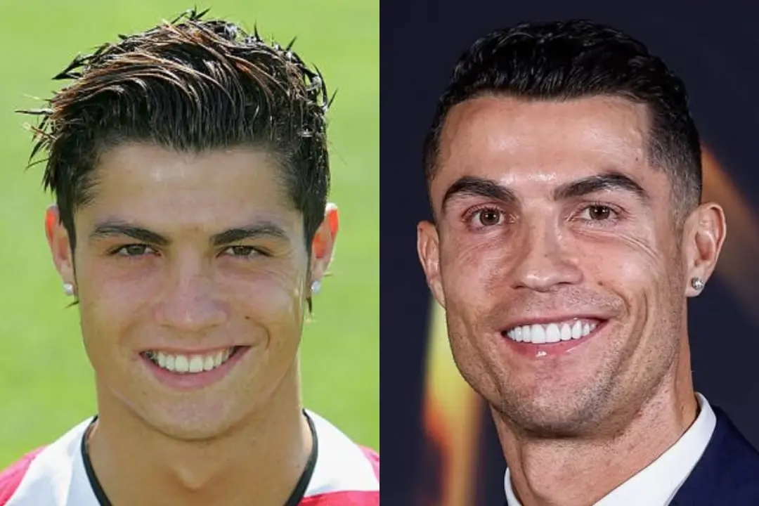 Cristiano Ronaldo teeth before after