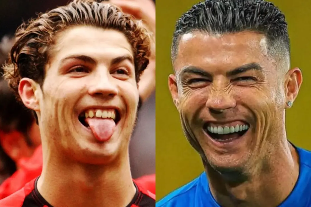 Cristiano Ronaldo teeth implant before after Cristiano Ronaldo teeth implant