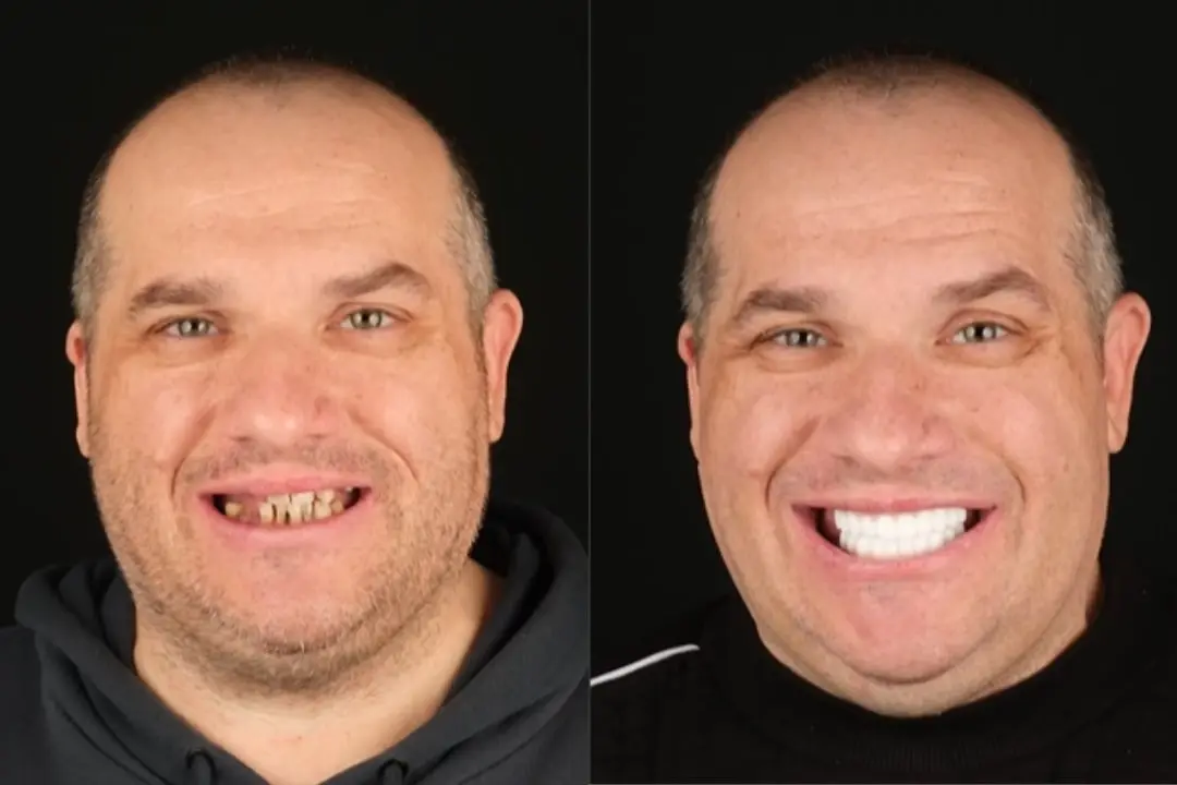 Simena Dental Clinic in Antalya for dental implants Simena Dental Clinic in Antalya for dental implants