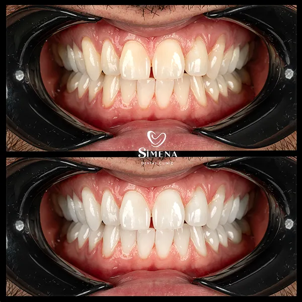 Teeth whitening treatment before after turkey