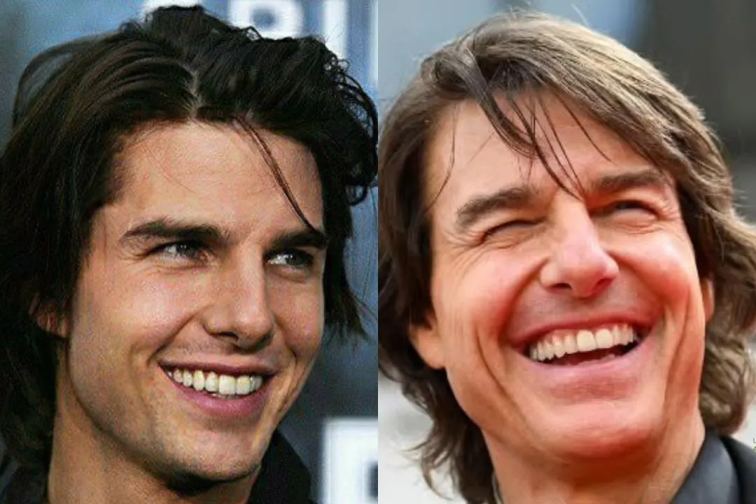 Tom Cruise porcelain veneers Tom Cruise porcelain veneers