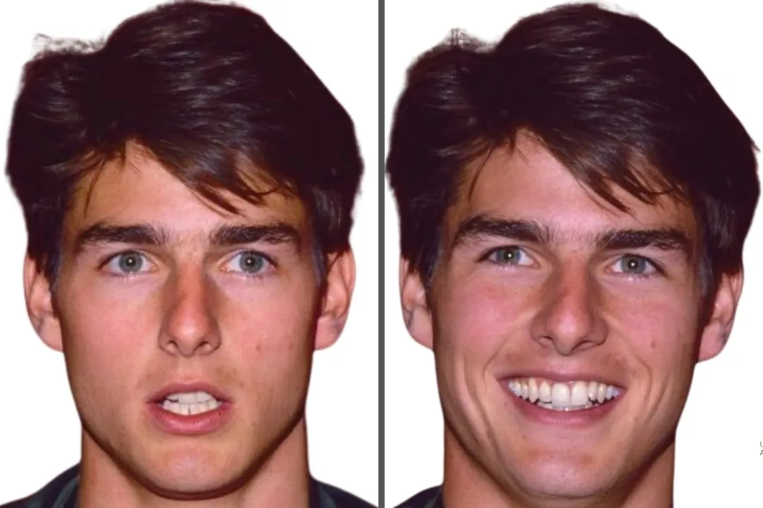 What was wrong with Tom Cruise's smile What was wrong with Tom Cruise's smile