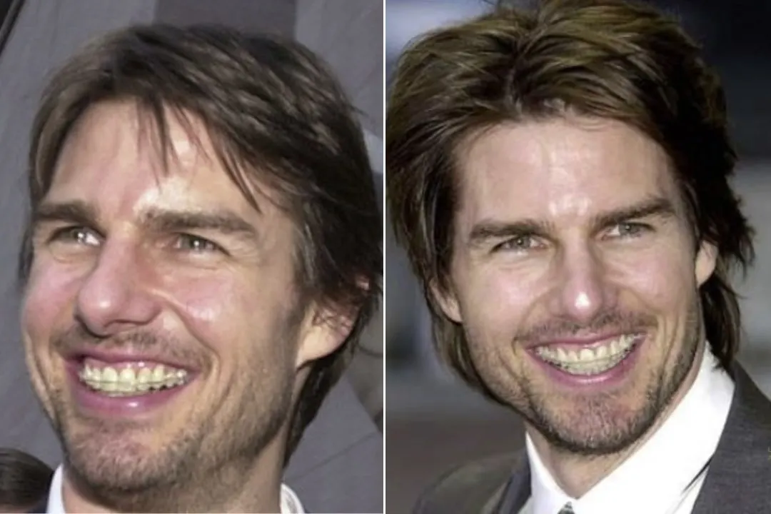 Tom Cruise dental braces Tom Cruise dental braces