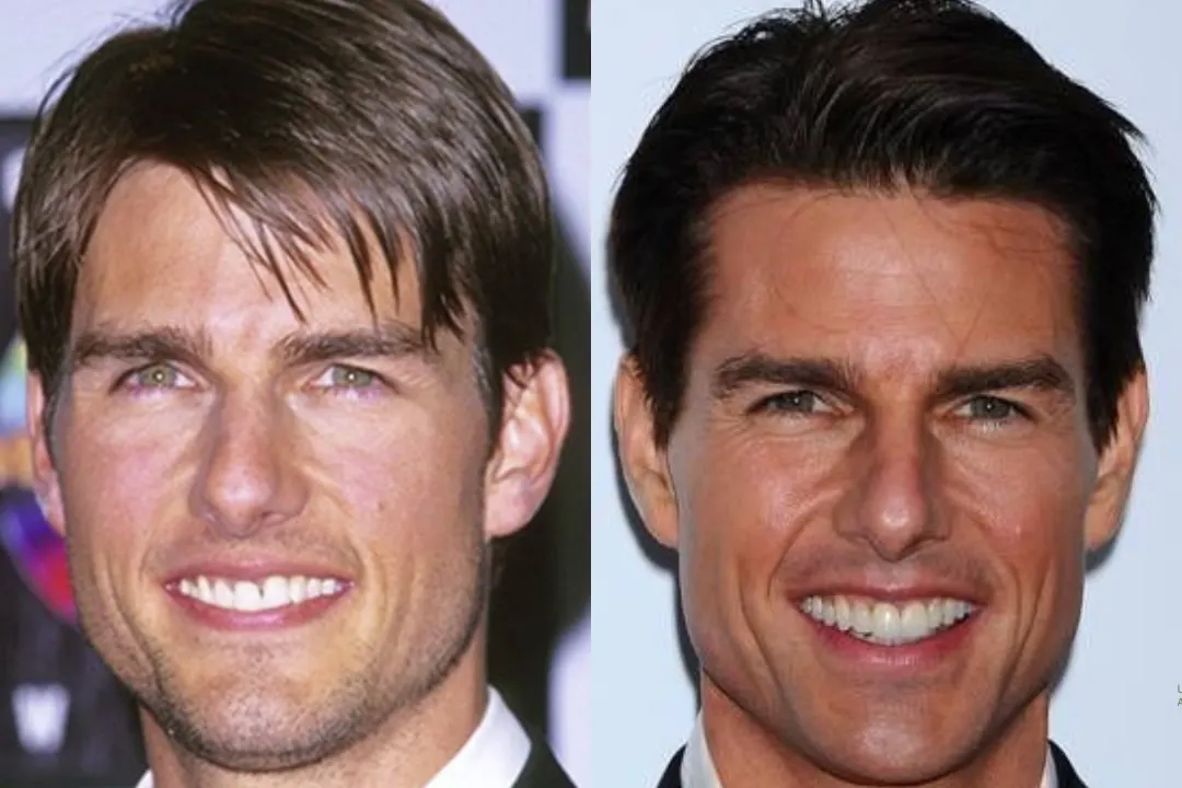 Tom Cruise tooth gap Tom Cruise tooth gap