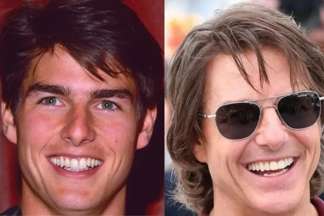 Tom Cruise dental veneers before after Tom Cruise dental veneers before after