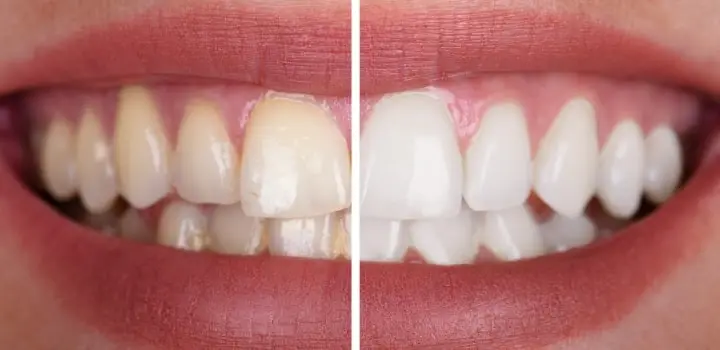 Tooth discoloration before after Tooth discoloration before after