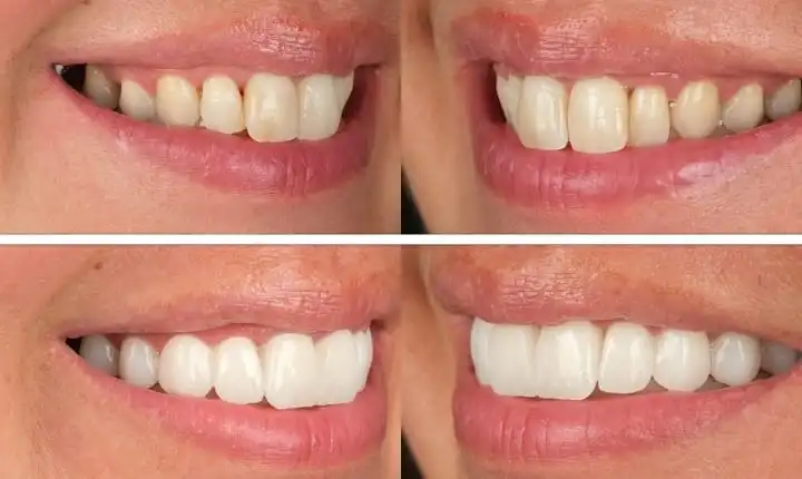 Zirconia crowns in Turkey
