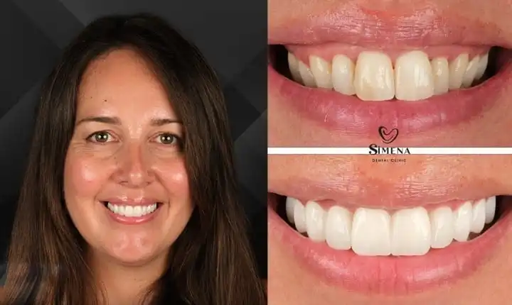 Dental crown in Turkey