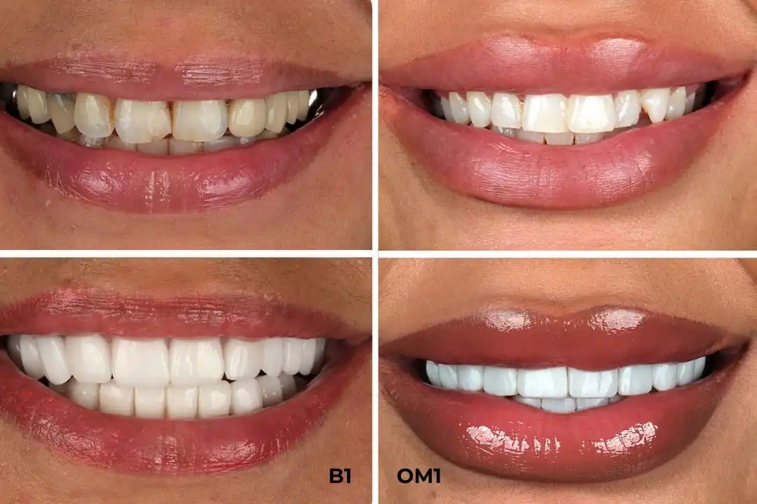 What is the whitest shade of teeth?