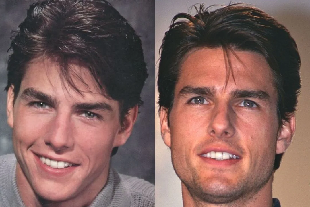 What was wrong with Tom Cruise teeth? What was wrong with Tom Cruise teeth?