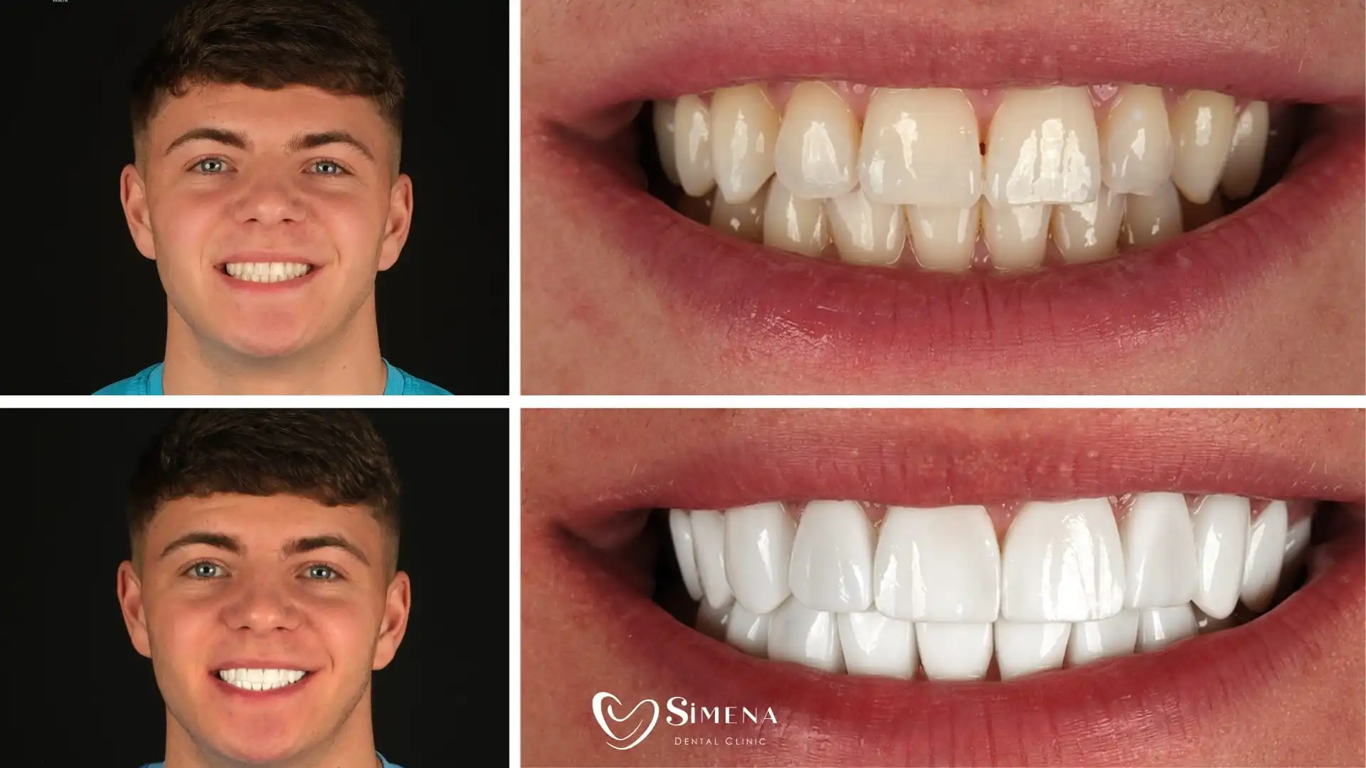 Why composite bonding and veneers in Simena?