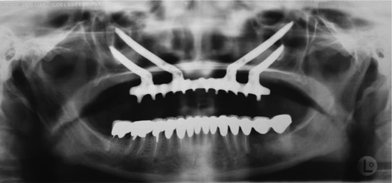 zygomatic implant treatment turkey